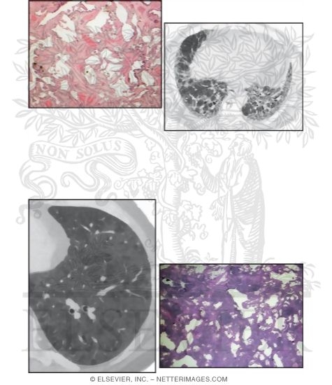 Idiopathic Interstitial Pneumonias