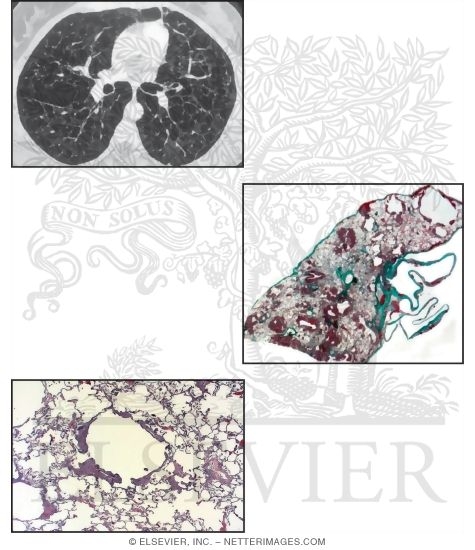 Watermarked preview of unlabeled image: Lymphangioleiomyomatosis