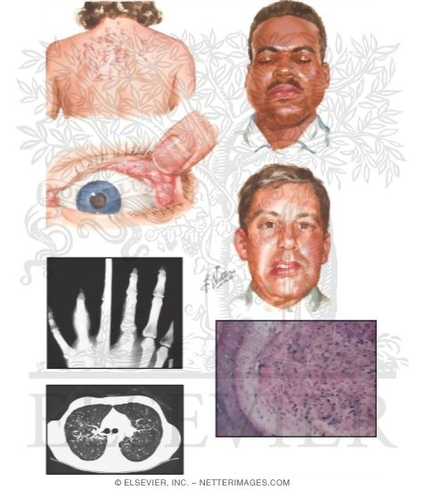 Watermarked preview of unlabeled image: Sarcoidosis