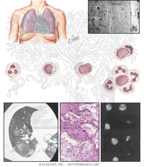 Watermarked preview of unlabeled image: Systemic Lupus Erythematosus