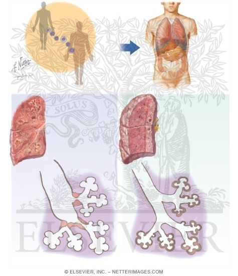Watermarked preview of unlabeled image: Pulmonary Manifestations of Other Diseases