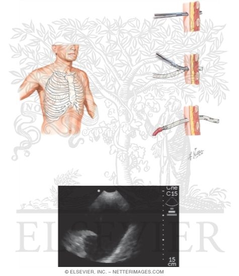 Introduction of Chest Drainage Tubes