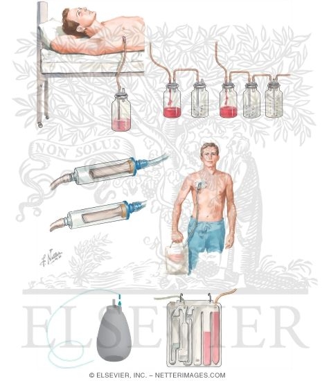 Chest-Draining Methods