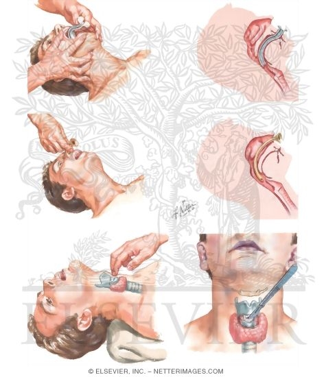 Securing an Emergent Airway
