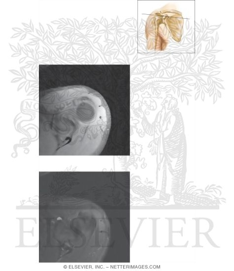 Watermarked preview of unlabeled image: Cross Section of the Shoulder: Axial View