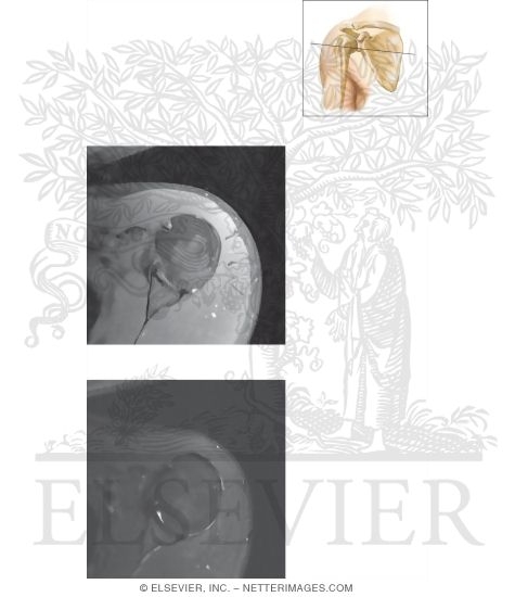 Watermarked preview of unlabeled image: Cross Section of the Shoulder: Axial View