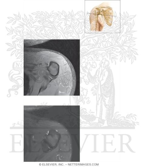 Watermarked preview of unlabeled image: Cross Section of the Shoulder: Axial View