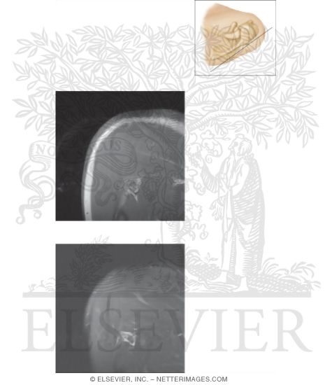 Watermarked preview of unlabeled image: Cross Section of the Shoulder: Coronal View