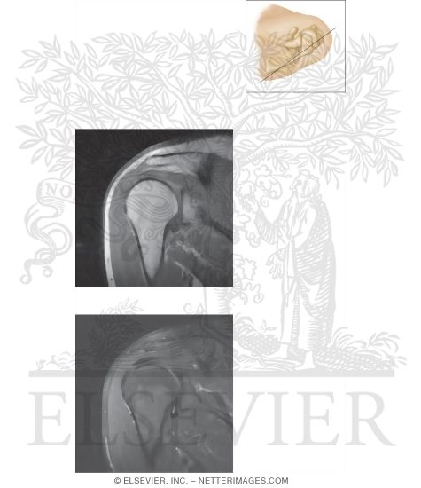 Watermarked preview of unlabeled image: Cross Section of the Shoulder: Coronal View