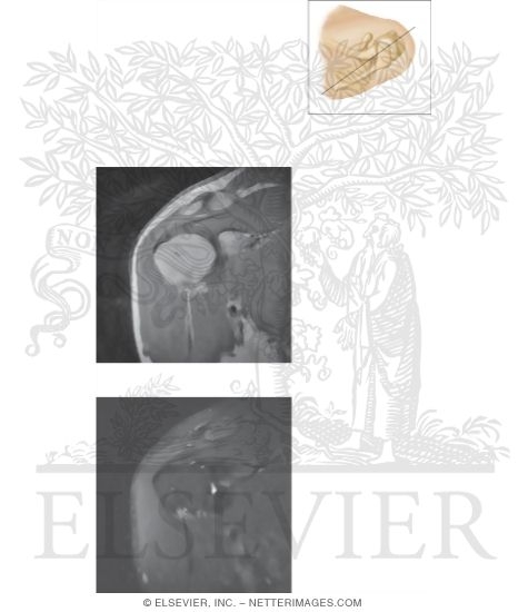 Watermarked preview of unlabeled image: Cross Section of the Shoulder: Coronal View