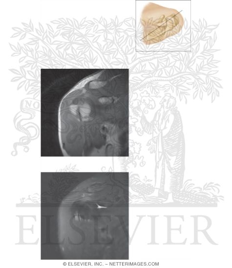Watermarked preview of unlabeled image: Cross Section of the Shoulder: Coronal View