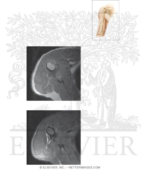 Watermarked preview of unlabeled image: Cross Section of the Upper Arm: Axial View