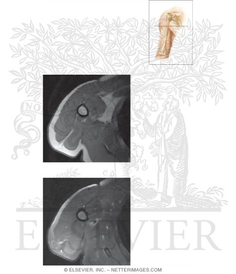 Watermarked preview of unlabeled image: Cross Section of the Upper Arm: Axial View