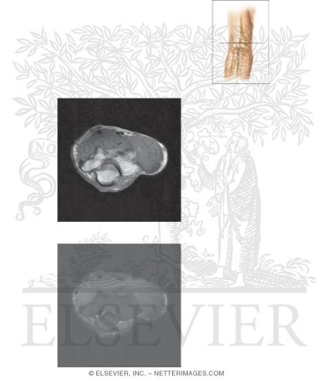 Watermarked preview of unlabeled image: Cross Section of the Elbow: Axial View