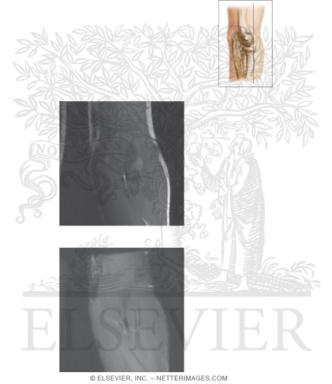 Watermarked preview of unlabeled image: Cross Section of the Elbow: Coronal View