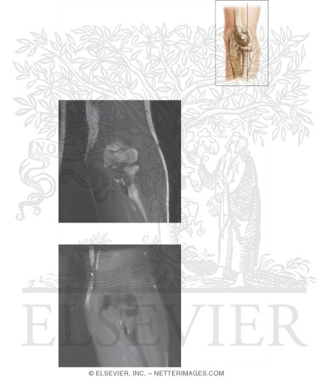 Watermarked preview of unlabeled image: Cross Section of the Elbow: Coronal View