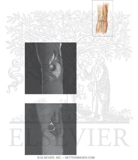 Watermarked preview of unlabeled image: Cross Section of the Elbow: Sagittal View