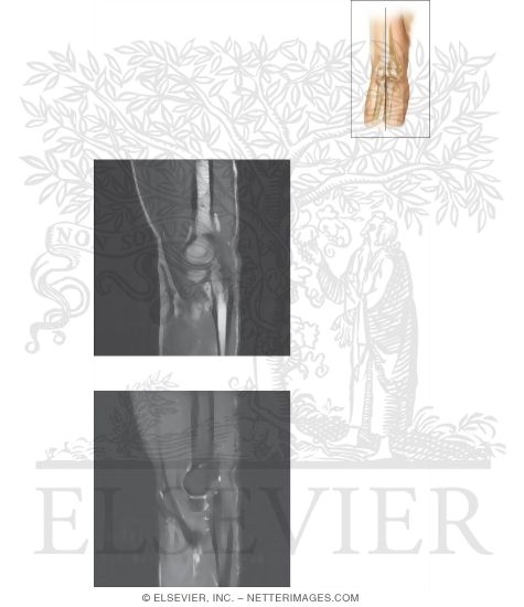 Watermarked preview of unlabeled image: Cross Section of the Elbow: Sagittal View