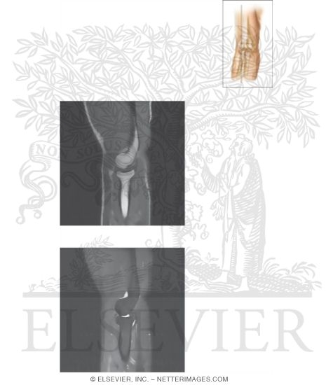 Watermarked preview of unlabeled image: Cross Section of the Elbow: Sagittal View