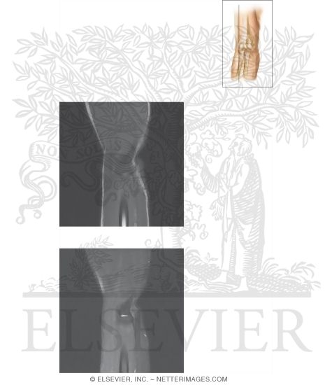 Watermarked preview of unlabeled image: Cross Section of the Elbow: Sagittal View