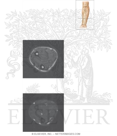 Watermarked preview of unlabeled image: Cross Section of the Forearm: Axial View