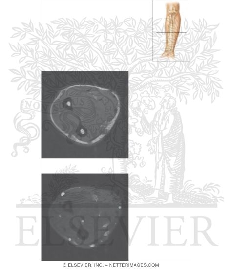 Cross Section of the Forearm: Axial View
