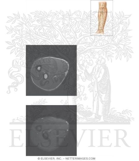 Watermarked preview of unlabeled image: Cross Section of the Forearm: Axial View