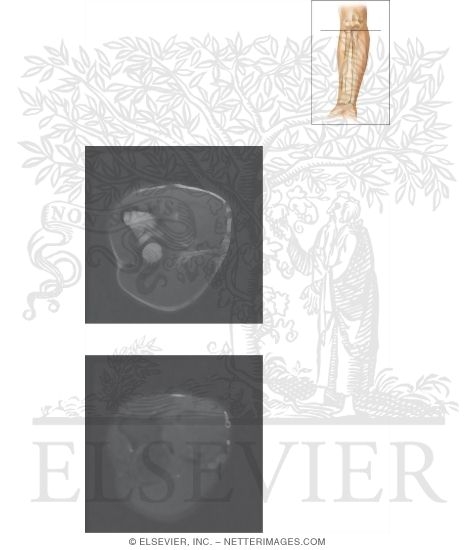 Watermarked preview of unlabeled image: Cross Section of the Forearm: Axial View