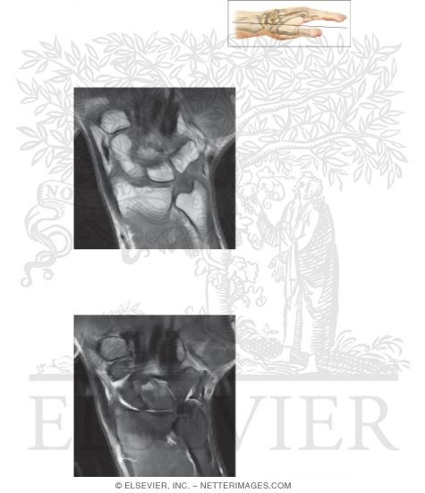 Cross Section of the Wrist: Coronal View