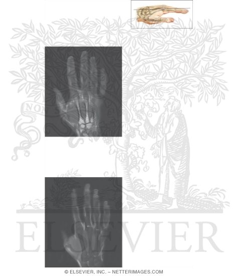 Watermarked preview of unlabeled image: Cross Section of the Hand and Finger: Coronal View