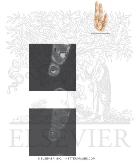 Watermarked preview of unlabeled image: Cross Section of the Thumb: Axial View