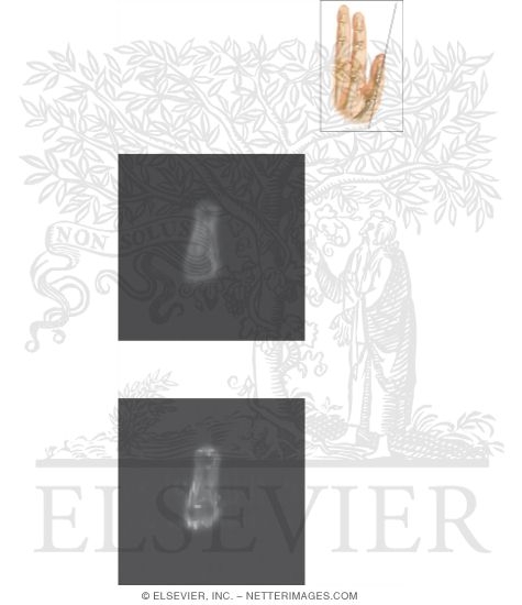 Watermarked preview of unlabeled image: Cross Section of the Thumb: Coronal View