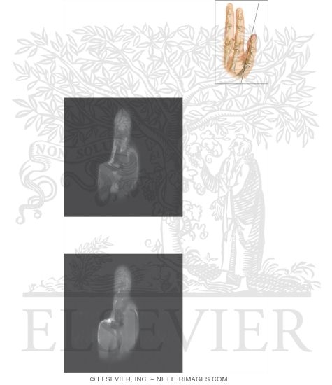 Watermarked preview of unlabeled image: Cross Section of the Thumb: Coronal View