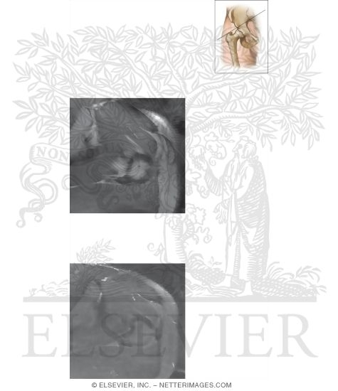 Watermarked preview of unlabeled image: Cross Section of the Hip: Axial Oblique View
