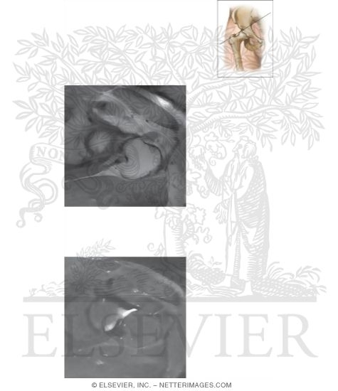 Watermarked preview of unlabeled image: Cross Section of the Hip: Axial Oblique View