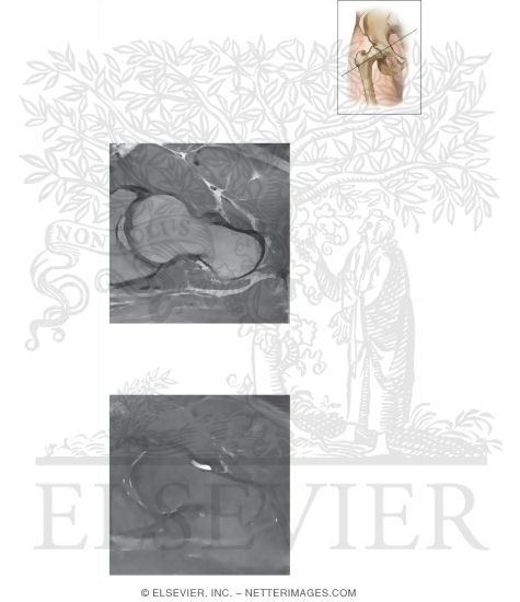 Watermarked preview of unlabeled image: Cross Section of the Hip: Axial Oblique View