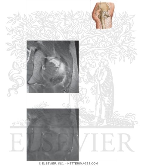 Watermarked preview of unlabeled image: Cross Section of the Hip: Coronal View