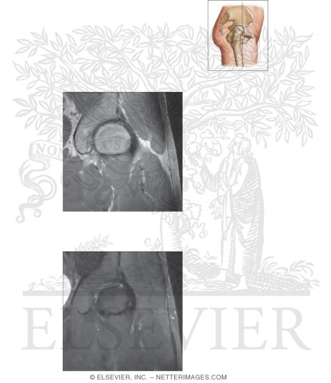 Watermarked preview of unlabeled image: Cross Section of the Hip: Coronal View