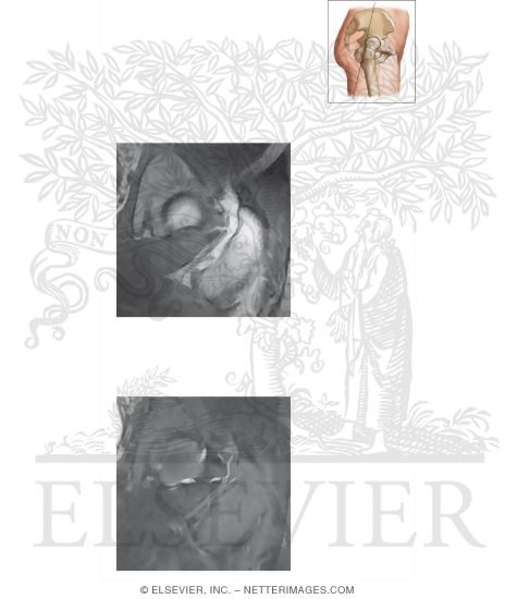 Watermarked preview of unlabeled image: Cross Section of the Hip: Coronal Oblique View