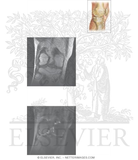 Cross Section of the Knee: Coronal View