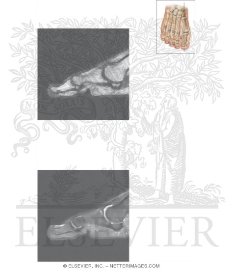 Watermarked preview of unlabeled image: Cross Section of the Plantar Plate: Sagittal View