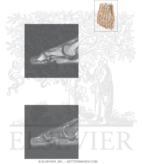 Watermarked preview of unlabeled image: Cross Section of the Plantar Plate: Sagittal View
