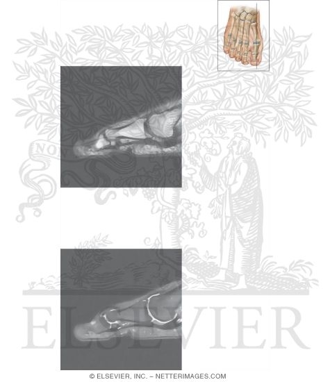 Watermarked preview of unlabeled image: Cross Section of the Plantar Plate: Sagittal View