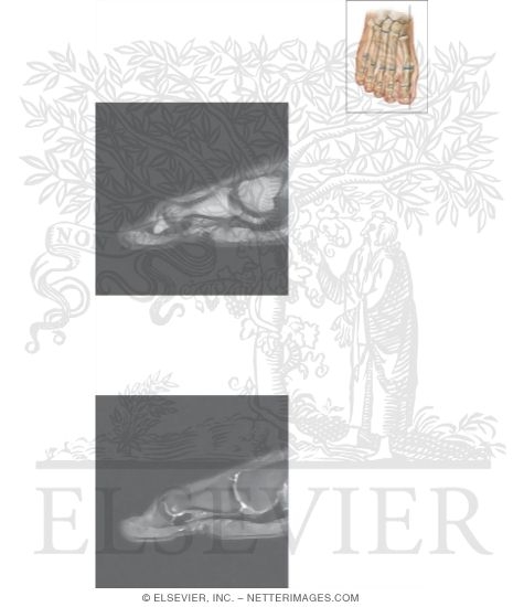 Watermarked preview of unlabeled image: Cross Section of the Plantar Plate: Sagittal View