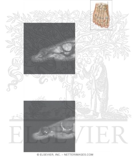 Watermarked preview of unlabeled image: Cross Section of the Plantar Plate: Sagittal View