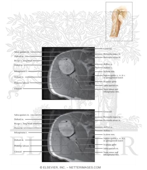 Cross Section of the Upper Arm: Axial View