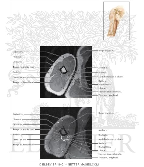 Watermarked preview of labeled image: Cross Section of the Arm: Axial View