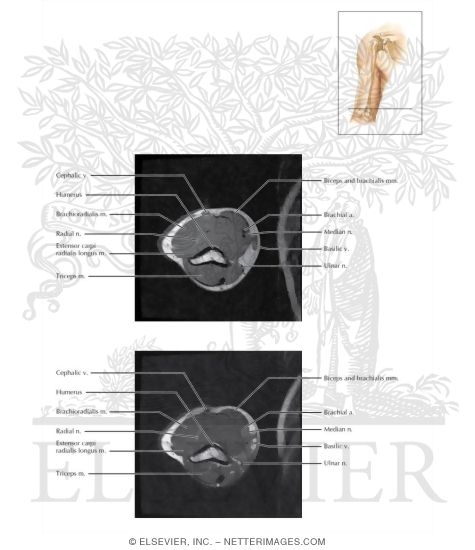 Watermarked preview of labeled image: Cross Section of the Arm: Axial View