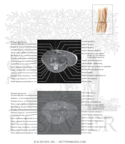 Watermarked preview of labeled image: Cross Section of the Elbow: Axial View
