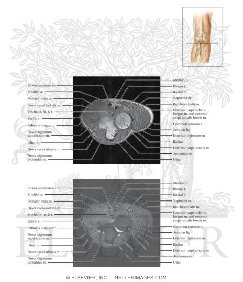 Watermarked preview of labeled image: Cross Section of the Elbow: Axial View